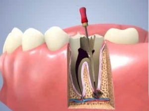 Get Root Canal Treatment in Pimple Saudagar