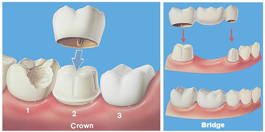 Get Crown and Bridge Treatment Pimple Saudagar | Crowns & Bridge in Pimple Saudagar - Dr. Shirish Yadav
