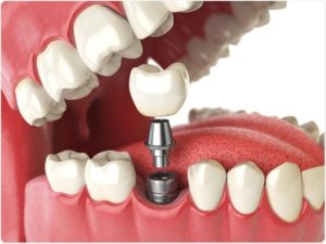 Get Best Dental Implant Clinic in Pimple Saudagar | Best Implants Service In Pimple Saudagar - Dr. Shirish Yadav