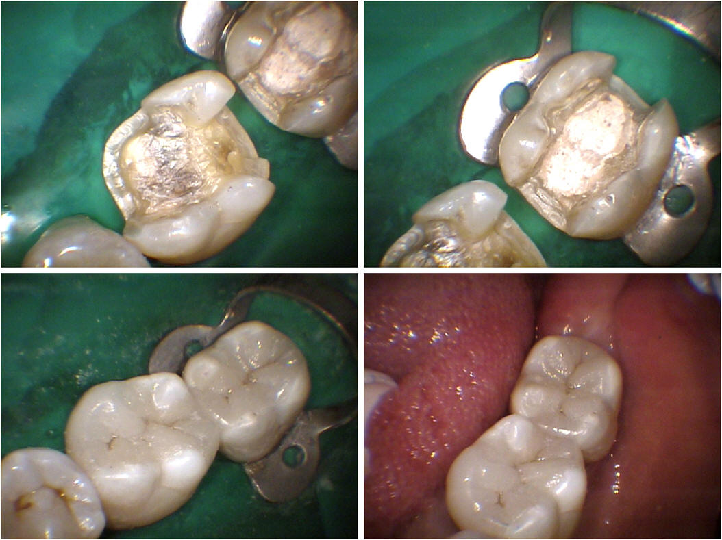 Find Ceramic Inlays/onlays in Pimple Saudagar | Inlays and Onlays in Pimple Saudagar - Dr. Shirish Yadav