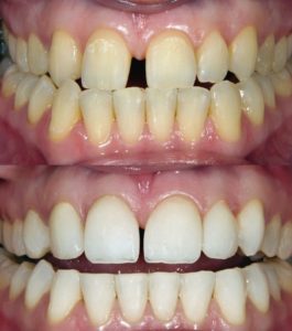 Find Dental Clinic in Pimple Saudagar | Dental Veneers Clinic in Pimple Saudagar - Dr. Shirish Yadav
